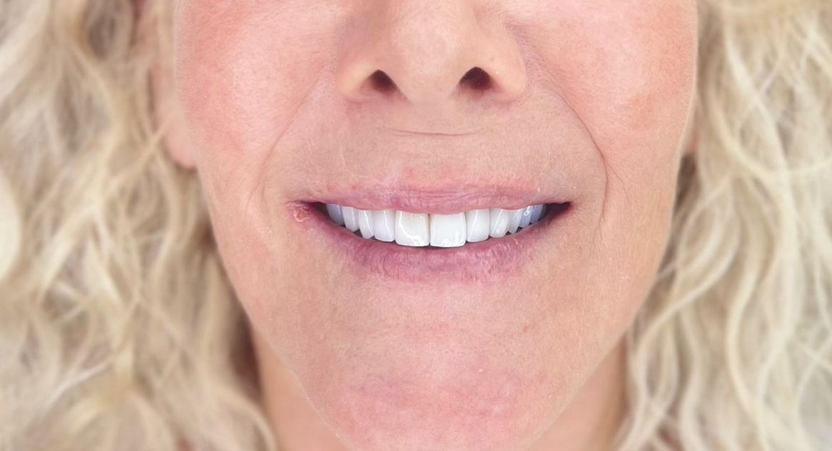 Dr. Raúl Villafañe Saldarriaga – Rehabilitación Oral e Implantes